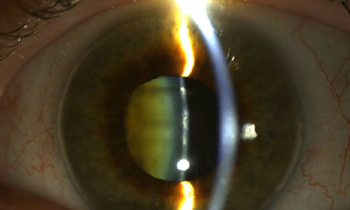 Slit lamp view of an eye with a cloudy, yellowed lens caused by a cataract