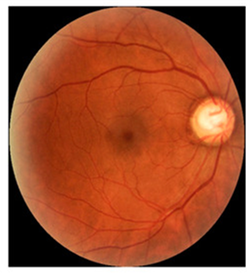 Retinal photograph showing an enlarged, cupped optic disc, a sign of glaucoma