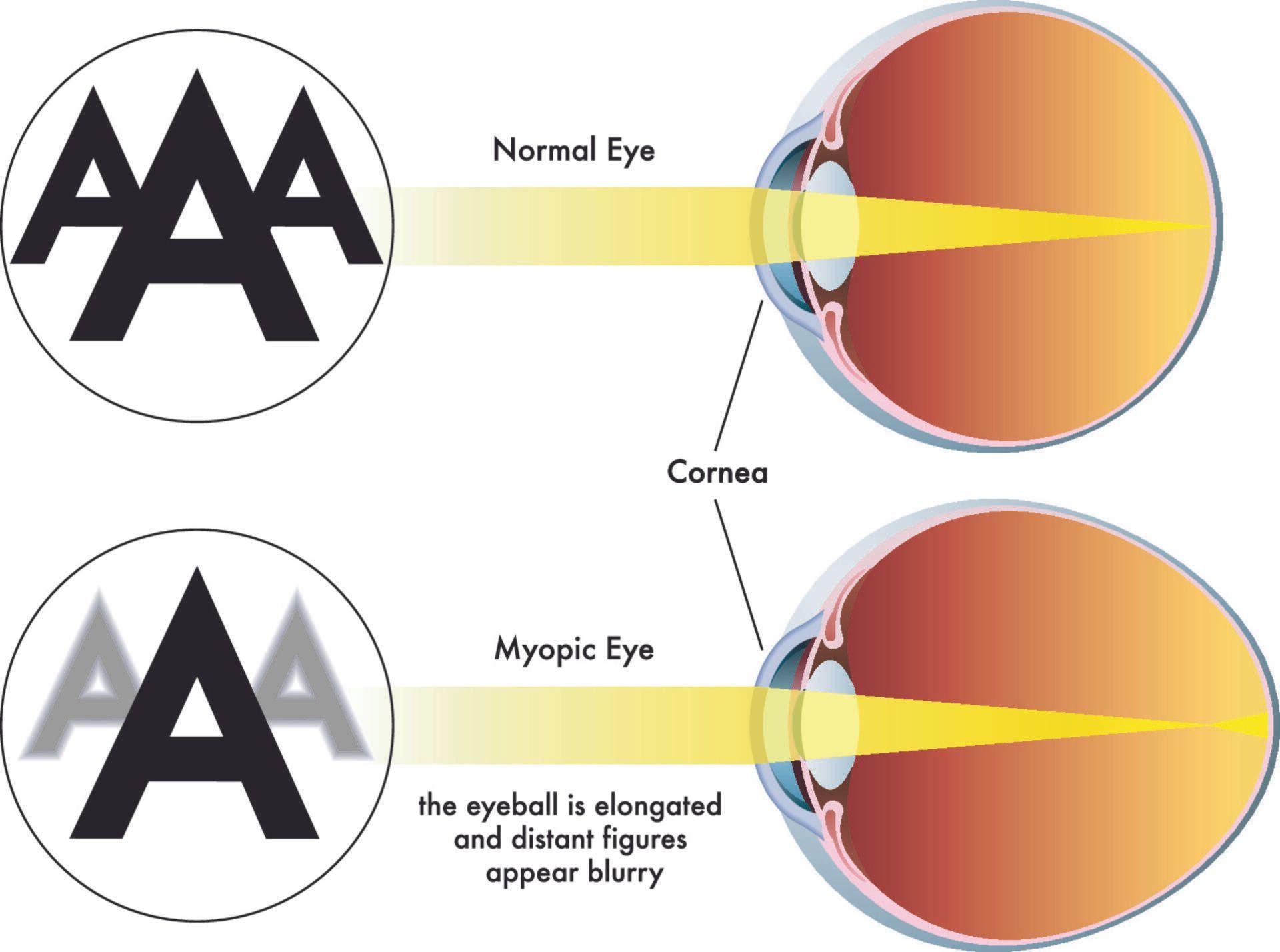 Diagram comparing a normal eye and a myopic eye